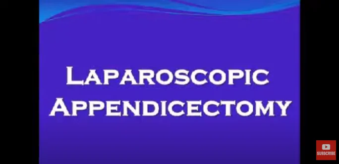 Laparoscopic Appendectomy-Appendix Surgery