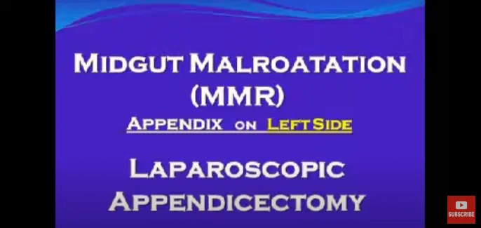 Laparoscopic Appendectomy (perforated appendix, left side appendix)