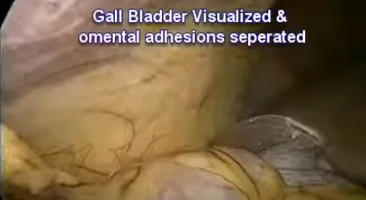 Laparoscopic Gall bladder Removal Surgery Chlecystectomy for Gall Bladder Stone Dr.Nitish Jhawar