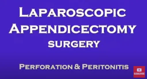 Laparoscopic Appendix Perforation and Peritonitis Dr Nitish Jhawar360p