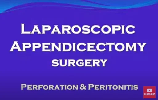 Laparoscopic Surgery (Appendectomy) for Complicated Appendicitis (Perforation Peritonitis)