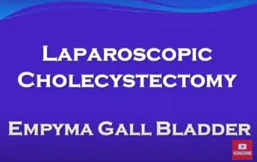 Empyema Gall Bladder –Laparoscopic Cholecystectomy