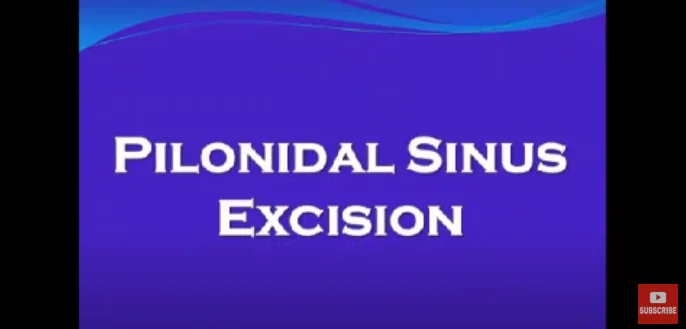 Pilonidal Sinus Excision Surgery