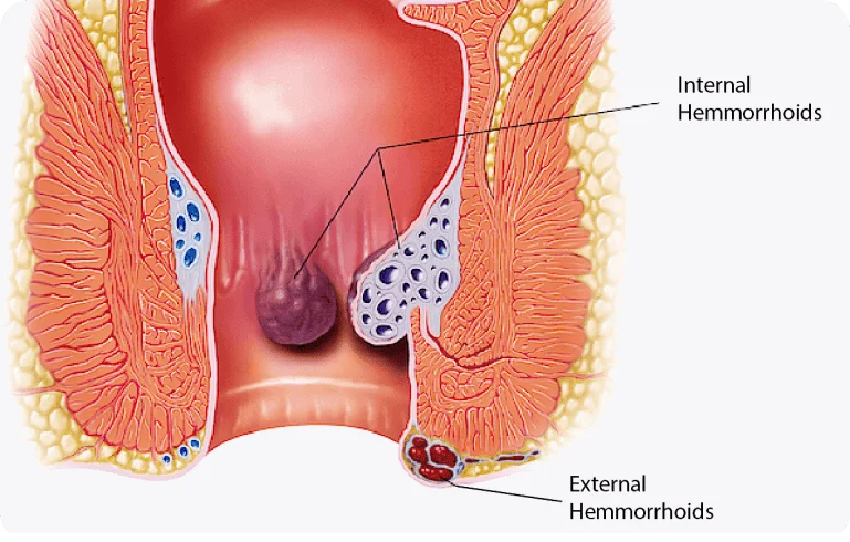 VAAFT Treatment in Navi Mumbai