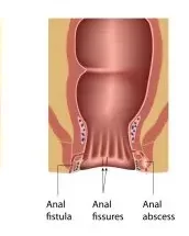 VAAFT Treatment in Navi Mumbai
