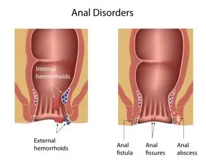 VAAFT Treatment in Navi Mumbai