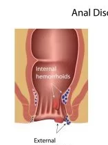 laser Fistula treatment