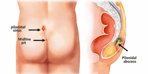 Laser Pilonidal Sinus Treatment in Navi Mumbai
