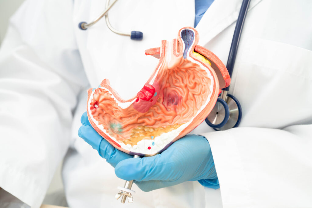 laparoscopic fundoplication surgery in Navi Mumbai